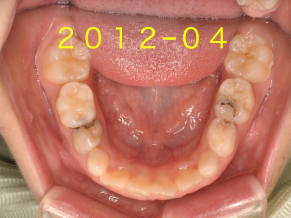 下の前歯.002