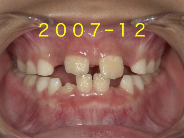 歯並び成長.003
