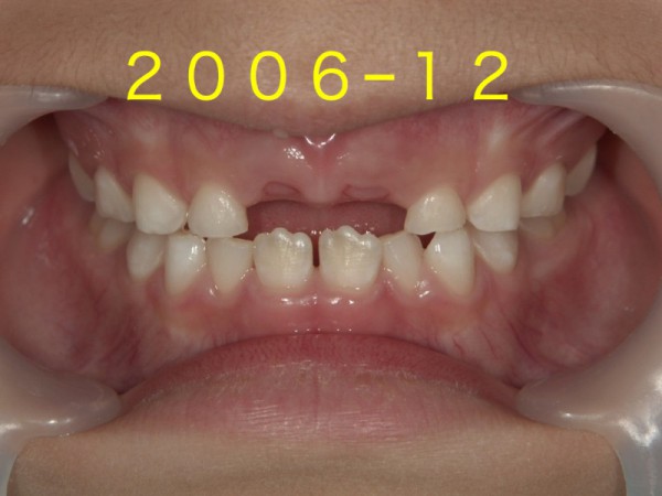 歯並び成長.002