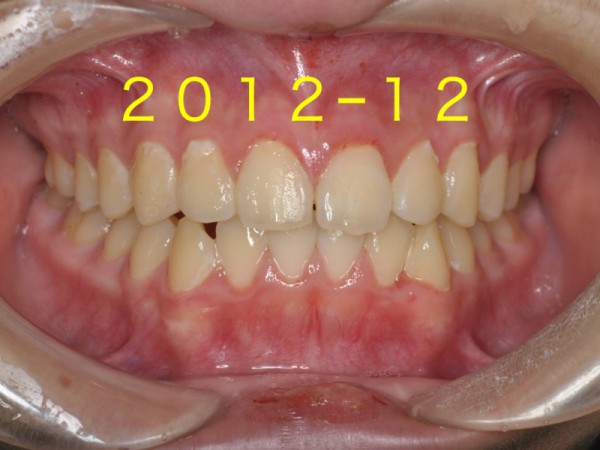 歯並び成長.004